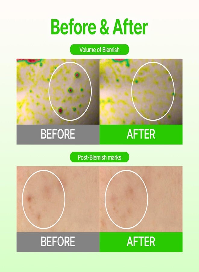 Acropass Microcone Pimple Patch Blemish Care - Post-Blemish, Redness, Dark Spot, Niacinamide, Dermatologist Tested, Non-Irritating, Cruelty Free (8 Count) - Image 3